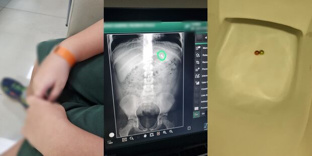 Criança de 8 anos engole bolinhas de imã em Campo Grande