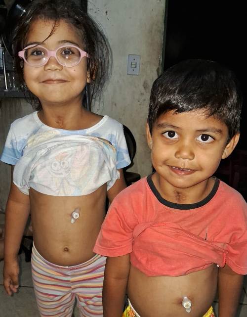 Irmãos só se alimentam por sonda e precisam de suplemento
