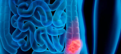 Preta Gil e o alerta silencioso do câncer colorretal: a importância da prevenção e do butirato