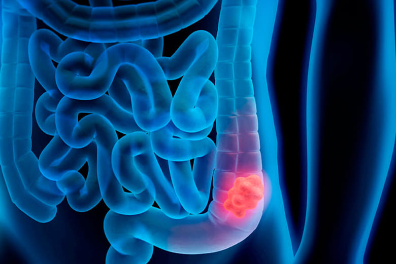 Preta Gil e o alerta silencioso do câncer colorretal: a importância da prevenção e do butirato