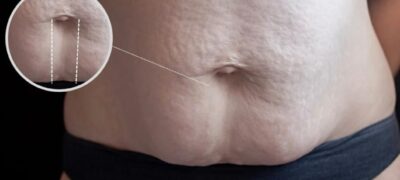 Diástase Abdominal: entenda as causas, complicações e novas soluções para uma vida com mais conforto