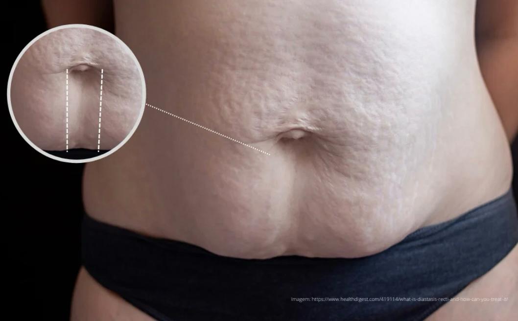 Diástase Abdominal: entenda as causas, complicações e novas soluções para uma vida com mais conforto