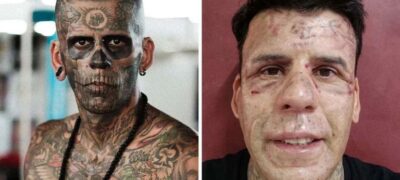 Homem revela rosto após dolorosa remoção de 170 tatuagens