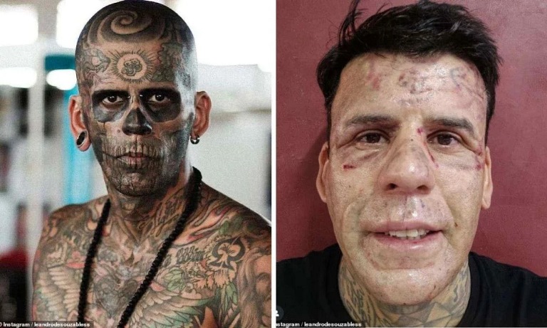 Homem revela rosto após dolorosa remoção de 170 tatuagens