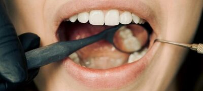 Saúde bucal: Por que minha gengiva sangra? Vejas dicas e orientações para cuidar de forma adequada