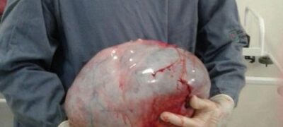 Médicos retiram tumor de 11 quilos de mulher que desconfiava de gravidez