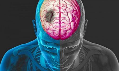 Entenda o que é o Acidente Vascular Cerebral, segunda maior causa de mortalidade no Brasil