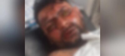 Mulher joga soda cáustica no rosto de ex-namorado que fica cego