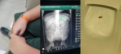 Criança de 8 anos engole bolinhas de imã em Campo Grande