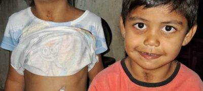 Irmãos só se alimentam por sonda e precisam de suplemento