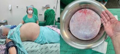 Do desespero ao milagre: jovem consegue cirurgia e retira cisto com mais de 25 cm em Campo Grande