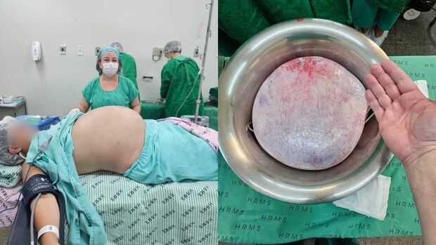Do desespero ao milagre: jovem consegue cirurgia e retira cisto com mais de 25 cm em Campo Grande
