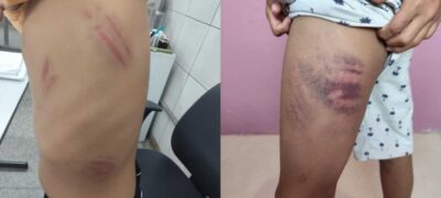 Menino autista é surrado dentro e fora da escola e Conselho Tutelar denuncia omissão