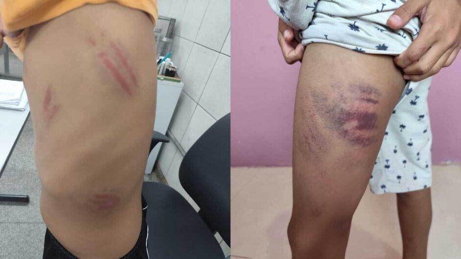 Menino autista é surrado dentro e fora da escola e Conselho Tutelar denuncia omissão