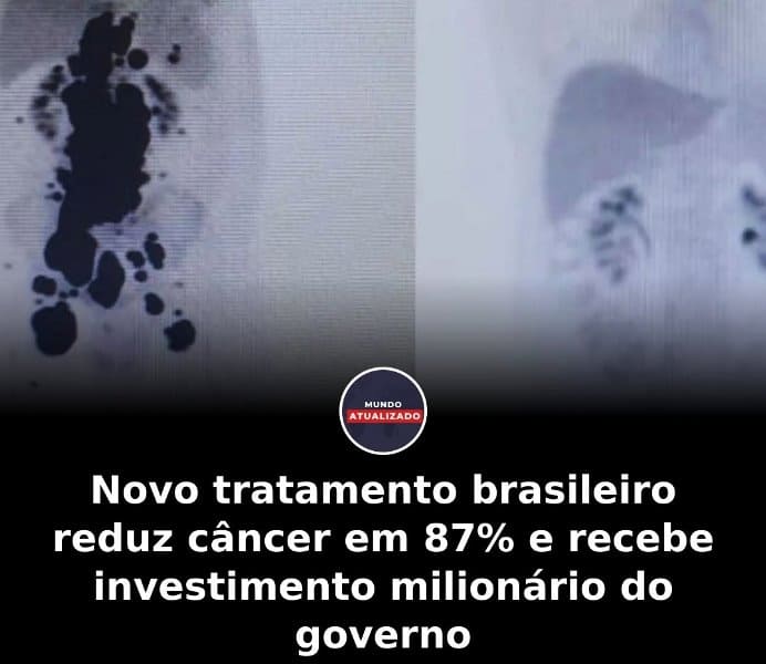 Novo tratamento brasileiro reduz câncer em 87% e recebe investimento milionário do governo