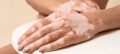 Vitiligo: saiba mais sobre esta doença autoimune, não contagiosa e imprevisível