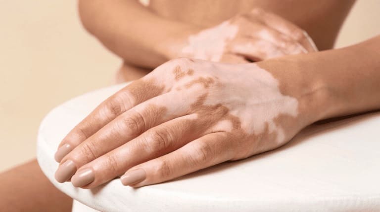 Vitiligo: saiba mais sobre esta doença autoimune, não contagiosa e imprevisível