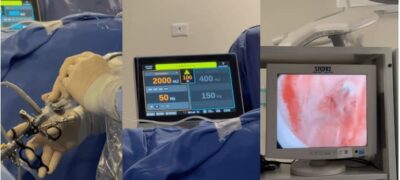 Humap-UFMS realiza cirurgias de próstata com laser de alta potência em pacientes do SUS