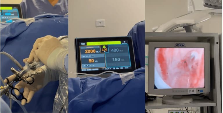 Humap-UFMS realiza cirurgias de próstata com laser de alta potência em pacientes do SUS